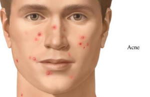 acne treatments in a dermatologists office