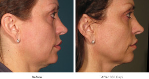 Tighten skin without surgery in Orange County