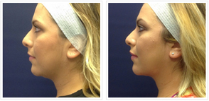 KYBELLA Patient Before and After (Side view)
