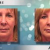 Woman - Before and after botox