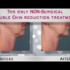 Before and after Kybella - Woman