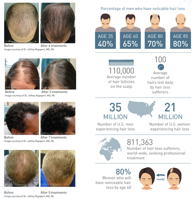 PRP Treatment for Hair Loss | Hair Restoration Orange County